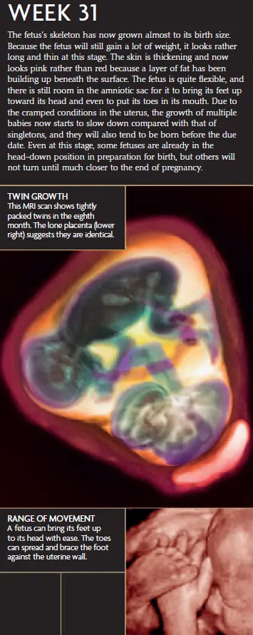 An MRI scan showing tightly packed twins at week 31 of pregnancy, with the image below displaying a 3D fetus in the womb with feet positioned toward its head.